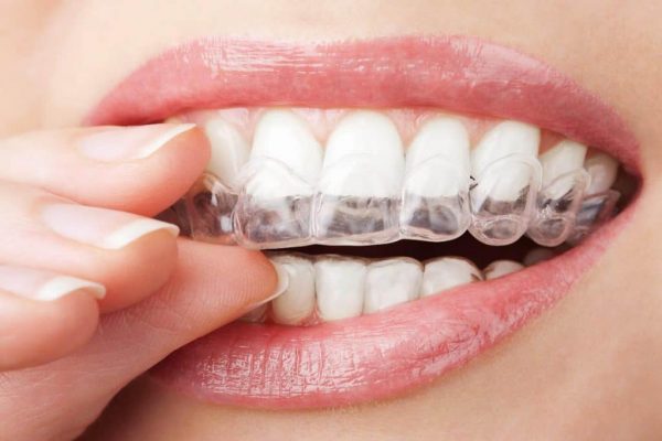 Why Do You Need Invisible Braces? 